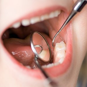 child’s mouth close-up with dental tools