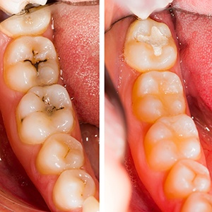 Teeth with tooth-colored fillings