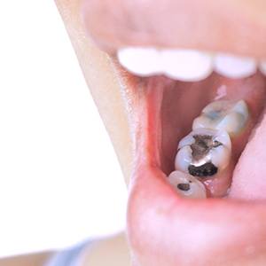 A child with metal fillings